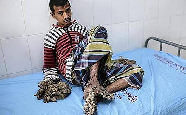 El 'hombre árbol' vuelve a sufrir el mismo calvario