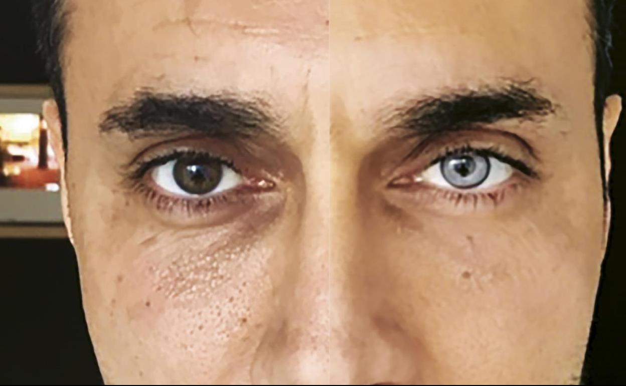 La nueva moda: operarse para tener los ojos azules | La Verdad