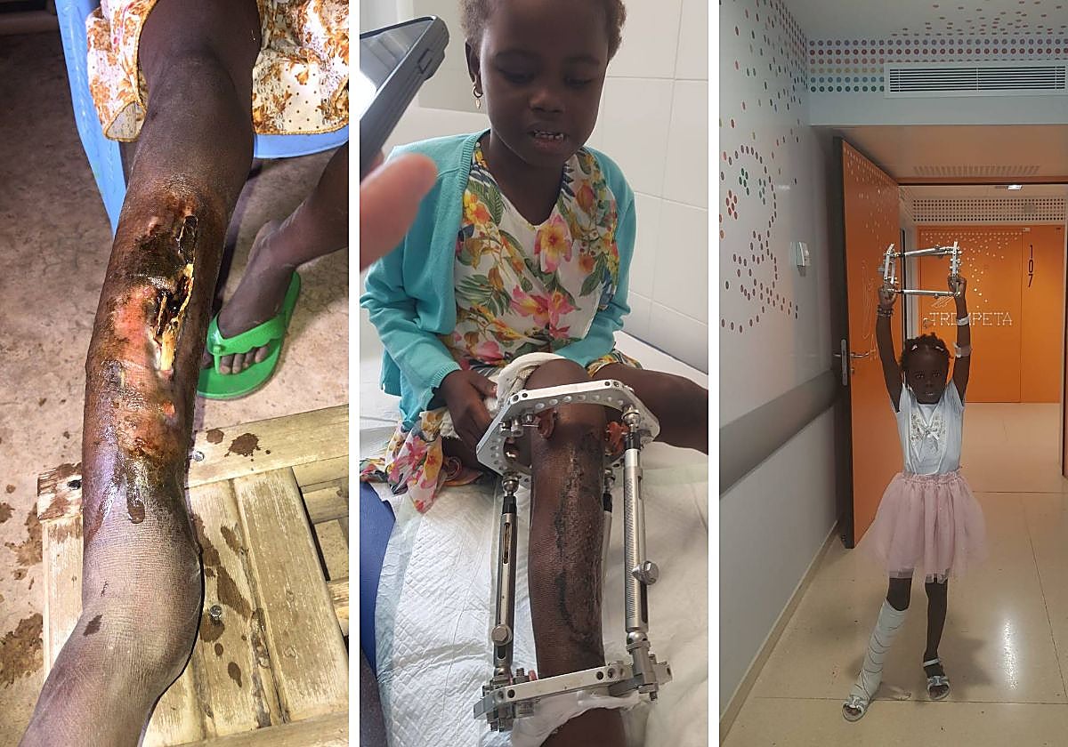 Bajo la gasa, descubren una herida abierta e infectada. El periodo de recuperación de la pierna de Kadilla es largo y complejo. Finalmente, Kadilla abandona el hospital completamente recuperada.