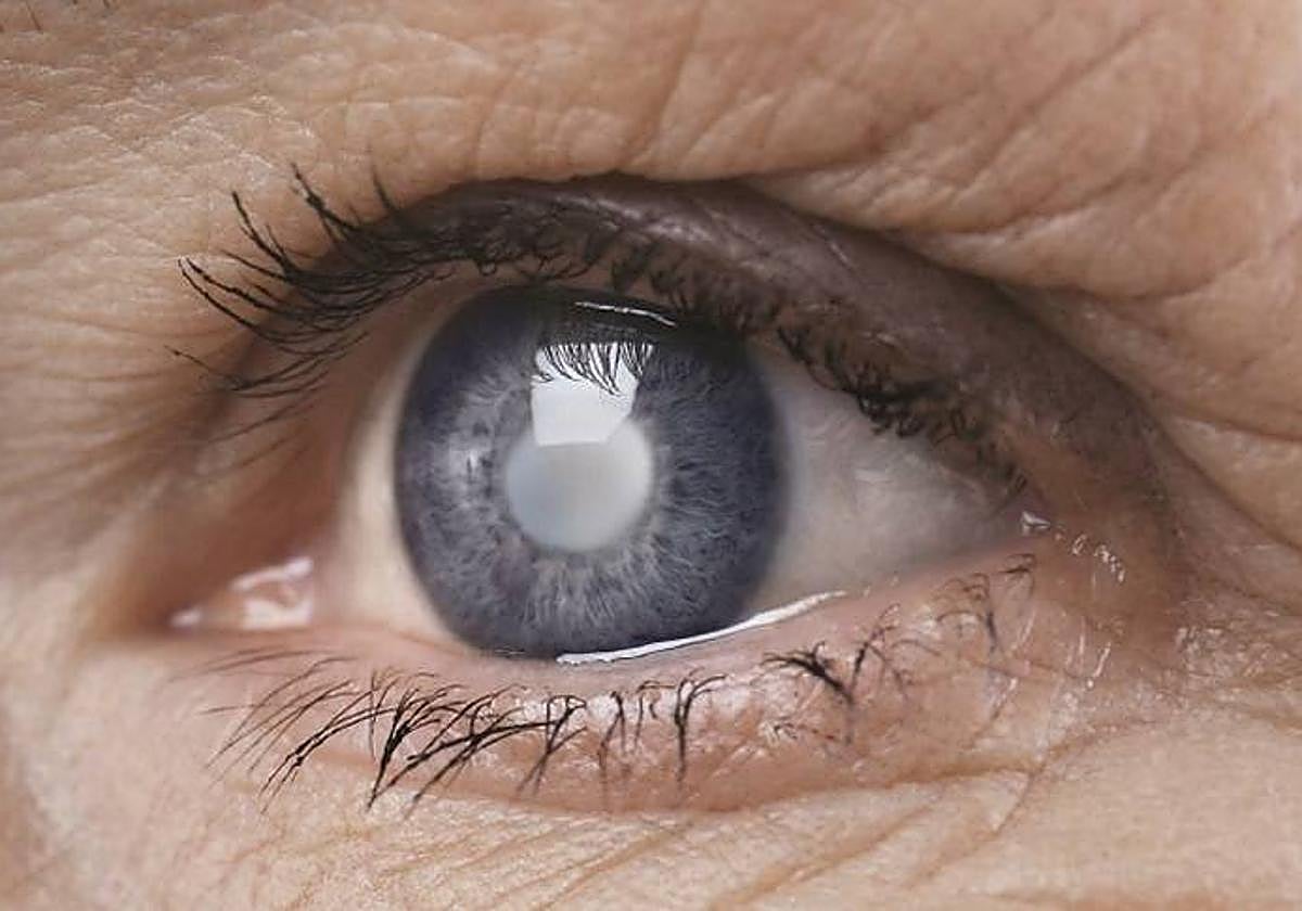 Recuperando la visión: operaciones de cataratas y lentes intraoculares en Quirónsalud Murcia