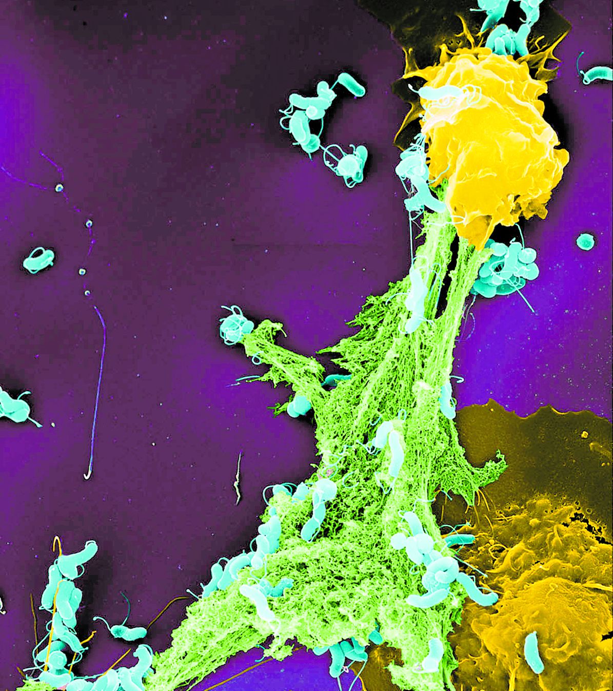 Momento captado al microscopio de la actuación de unos neutrófilos durante un proceso de infección.