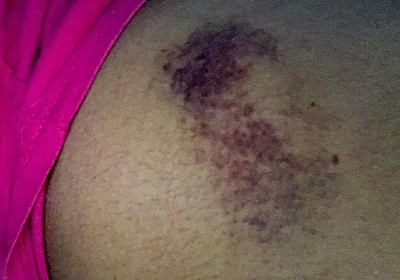 Moratón por los golpes que recibió la chica.