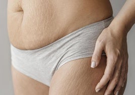 Cuerpo de mujer con estrías.