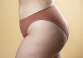 ¿Por qué salen las estrías? Las siete causas más comunes