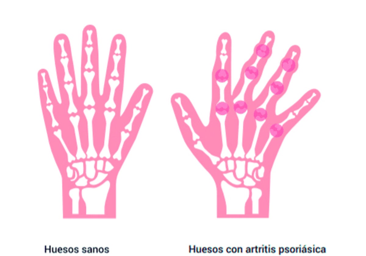 Artritis psoriásica una enfermedad más allá de la piel