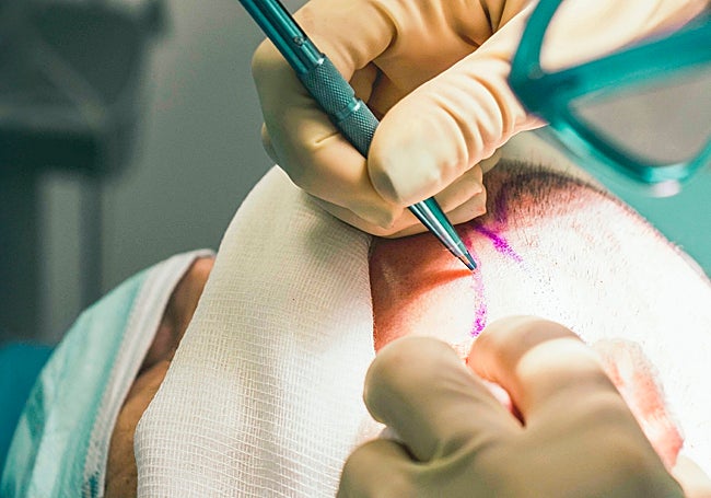 La técnica FUE con bisturí de zafiro que aplica Hospital Capilar logra resultados muy naturales.