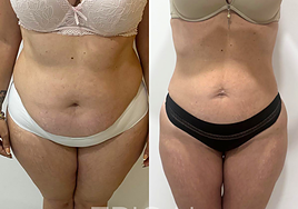 El antes y el después de una paciente que ha eliminado grasa del abdomen y muslos en Epical Clinic.