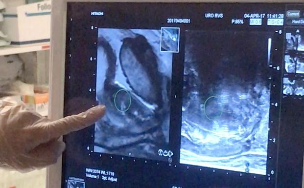 Proceso de biopsia prostática por fusión.