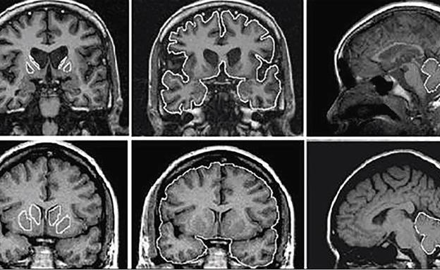 Imágenes de un cerebro afectado por la enfermedad de Huntington (arriba) y abajo, un cerebro sano.