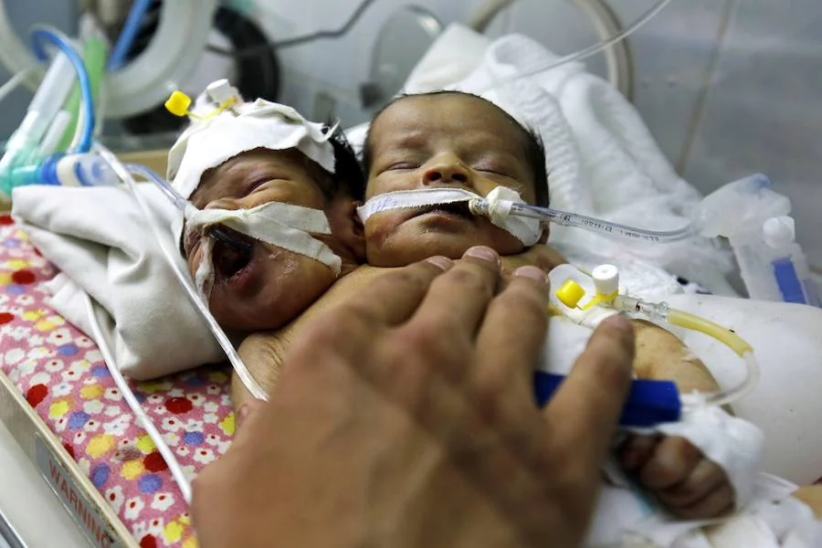 Fotos: Nacen dos siameses en Yemen