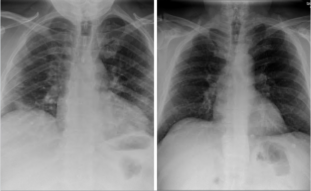 Comparación de dos radiografías pulmonares. Izquierda: pulmones infectados de coronavirus. Derecha: pulmones sanos.