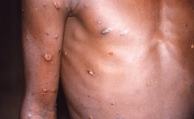 Imagen de las lesiones en la piel provocadas por la viruela del mono, durante un estudio llevado a cabo en la República Democrática del Congo entre los años 1996 y 1997.