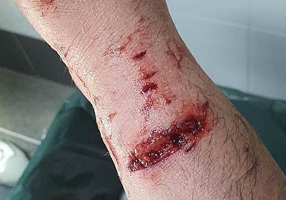 Heridas en el brazo del hombre provocadas por el ataque de los perros.
