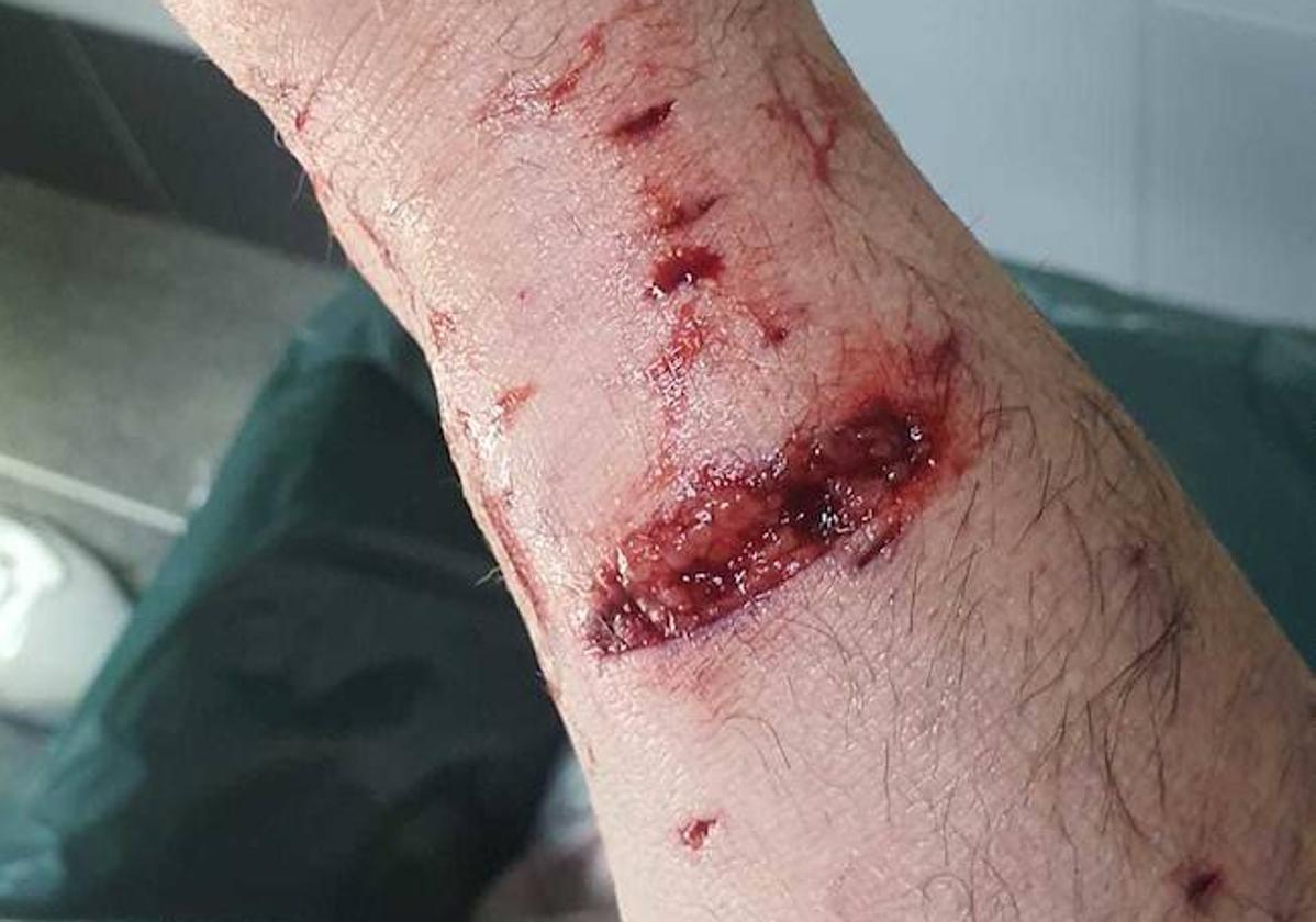 Heridas en el brazo del hombre provocadas por el ataque de los perros.