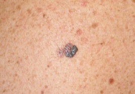 Imagen de archivo de un melanoma.