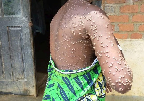 Una persona contagiada con mpox en el este de la República Democrática del Congo