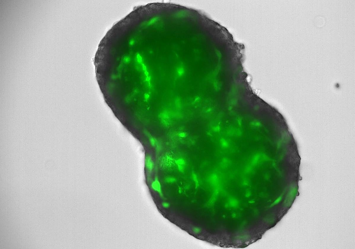 Tipo de cáncer al que nos referimos.