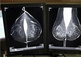 Mamografía para detectar un posible daño.