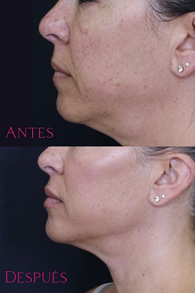 Antes y después del tratamiento Skin 360º efectuado en un paciente