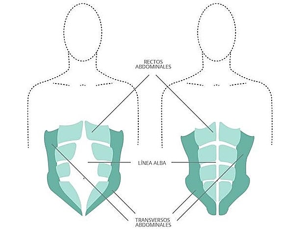La diástasis es la separación de los músculos recto abdominales con rotura de la línea alba, provocando un abultamiento del abdomen.