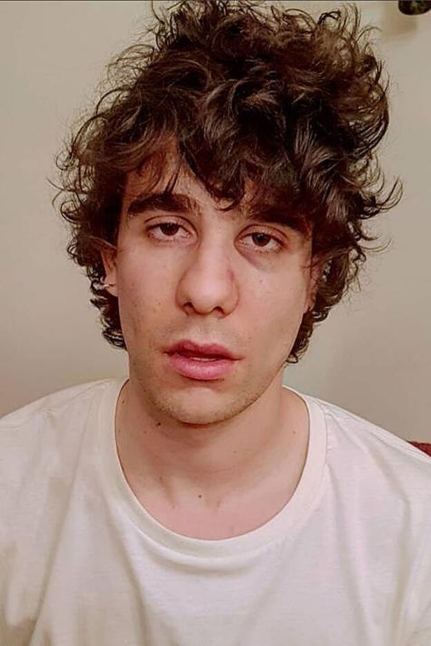 Javier Calvo muestra su cara hinchada tras recibir un puñetazo en Lisboa.