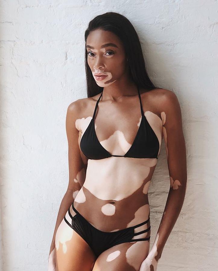 Winnie Harlow.