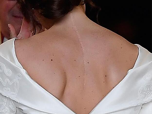 La princesa de York no quiso tapar con maquillaje la cicatriz de su espalda, debida a su operación de esclerosis.