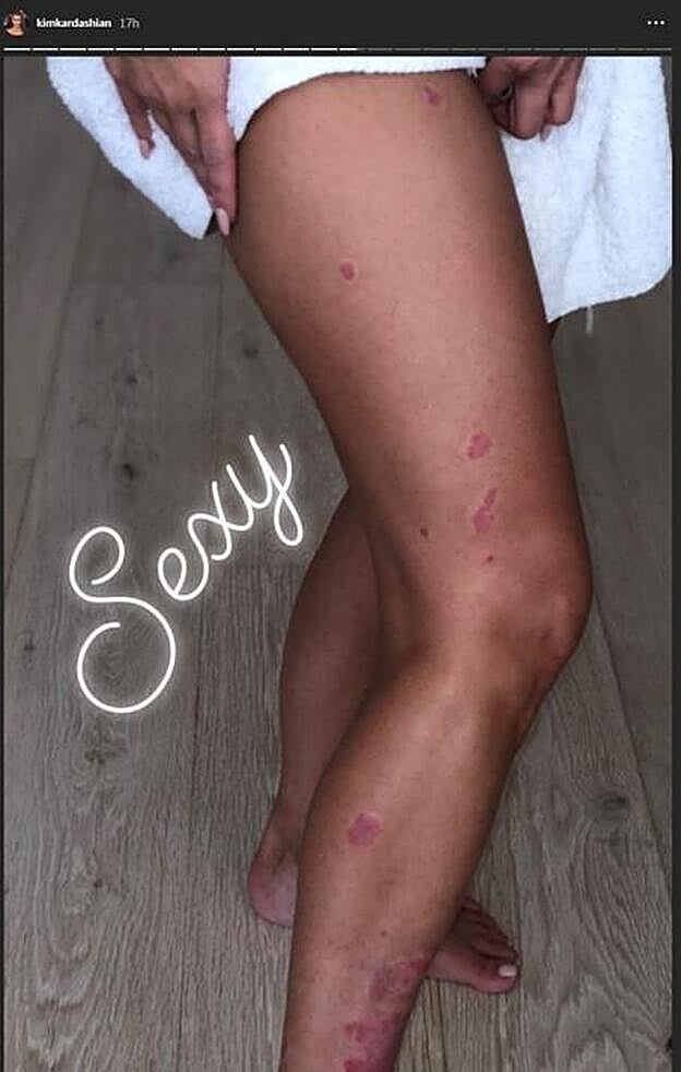 Kim Kardashian muestra las efectos de la psoriasis en sus piernas.
