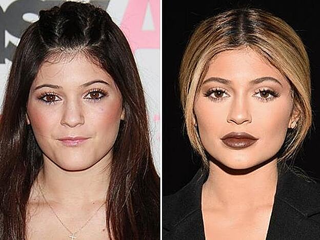 La nariz de adolescente de Kylie Jenner y su nariz remodelada.