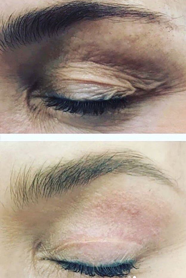 El antes y el después de un tratamiento con el láser PLEXR.