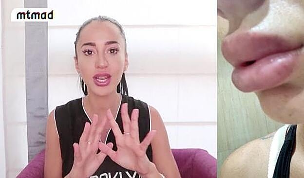 Así quedó el labio de Aurah Ruiz tras el retoque.