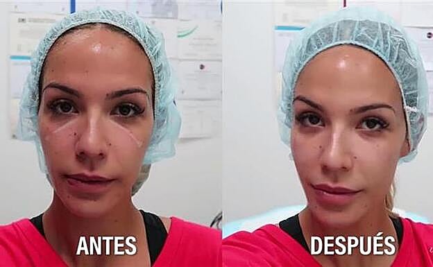 Galería. Tamara Gorro muestra el antes y el después de ese retoque estético para quitarse las ojeras. Pincha sobre la foto para ver las famosas que se han retocado la cara.