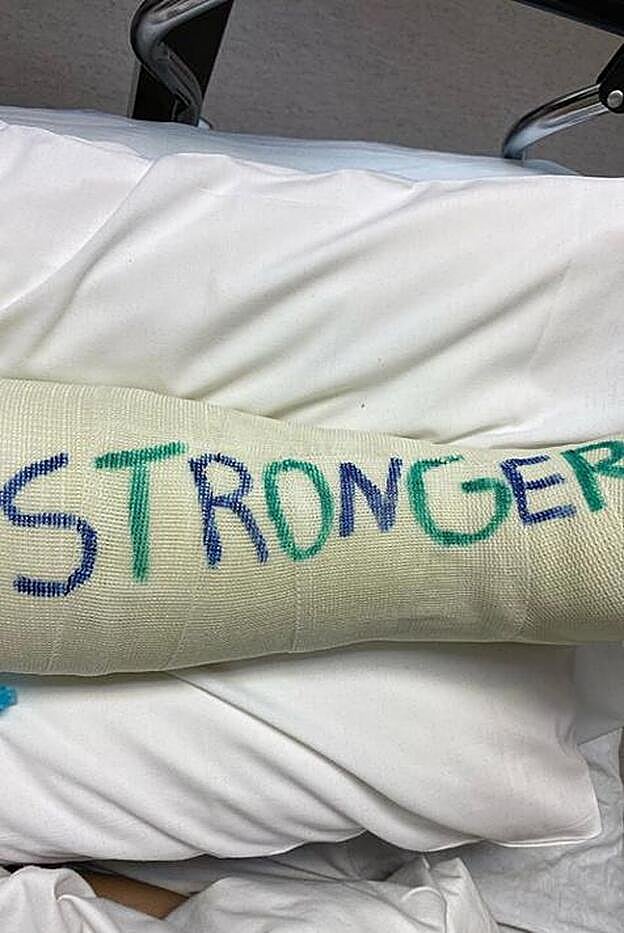 Así luce la pierna de Britney tras fracturarse un hueso del pie.