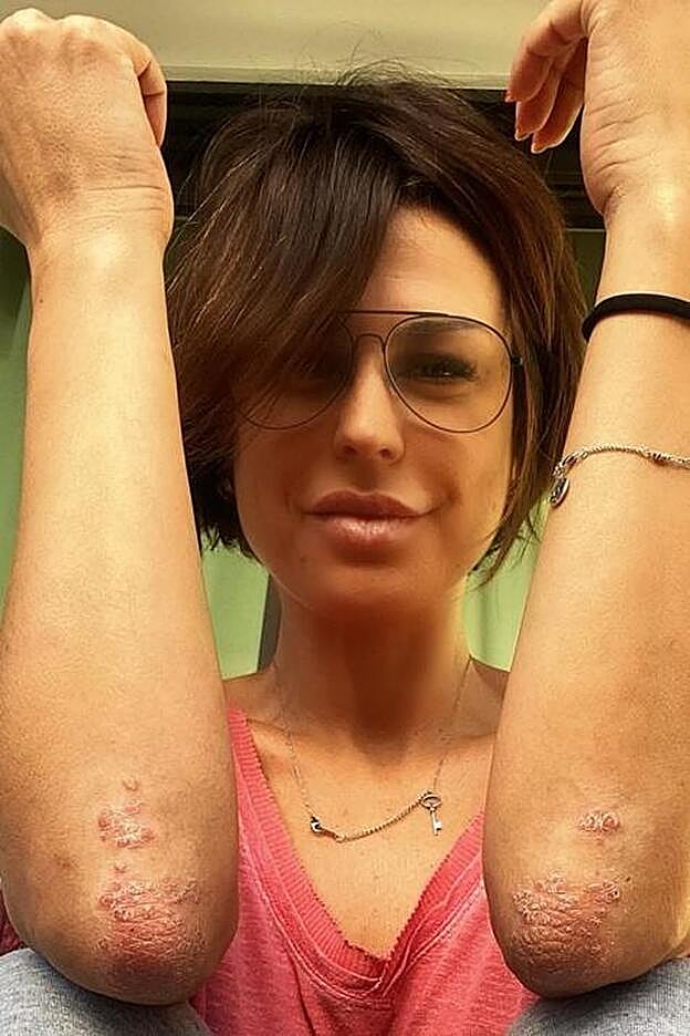 Raquel ha mostrado las marcas de su enfermedad.