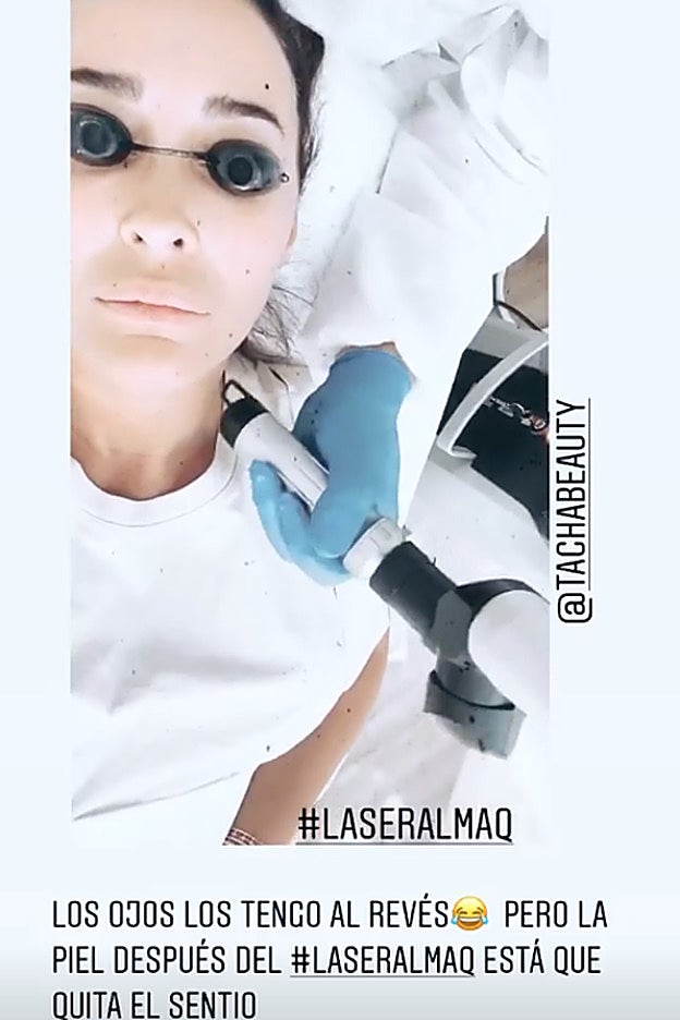 El tratamiento láser que Vicky Martín Berrocal recibe en la piel del rostro.
