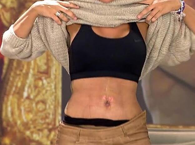 Así ha quedado el abdomen de Marta López tras pasar por el quirófano.