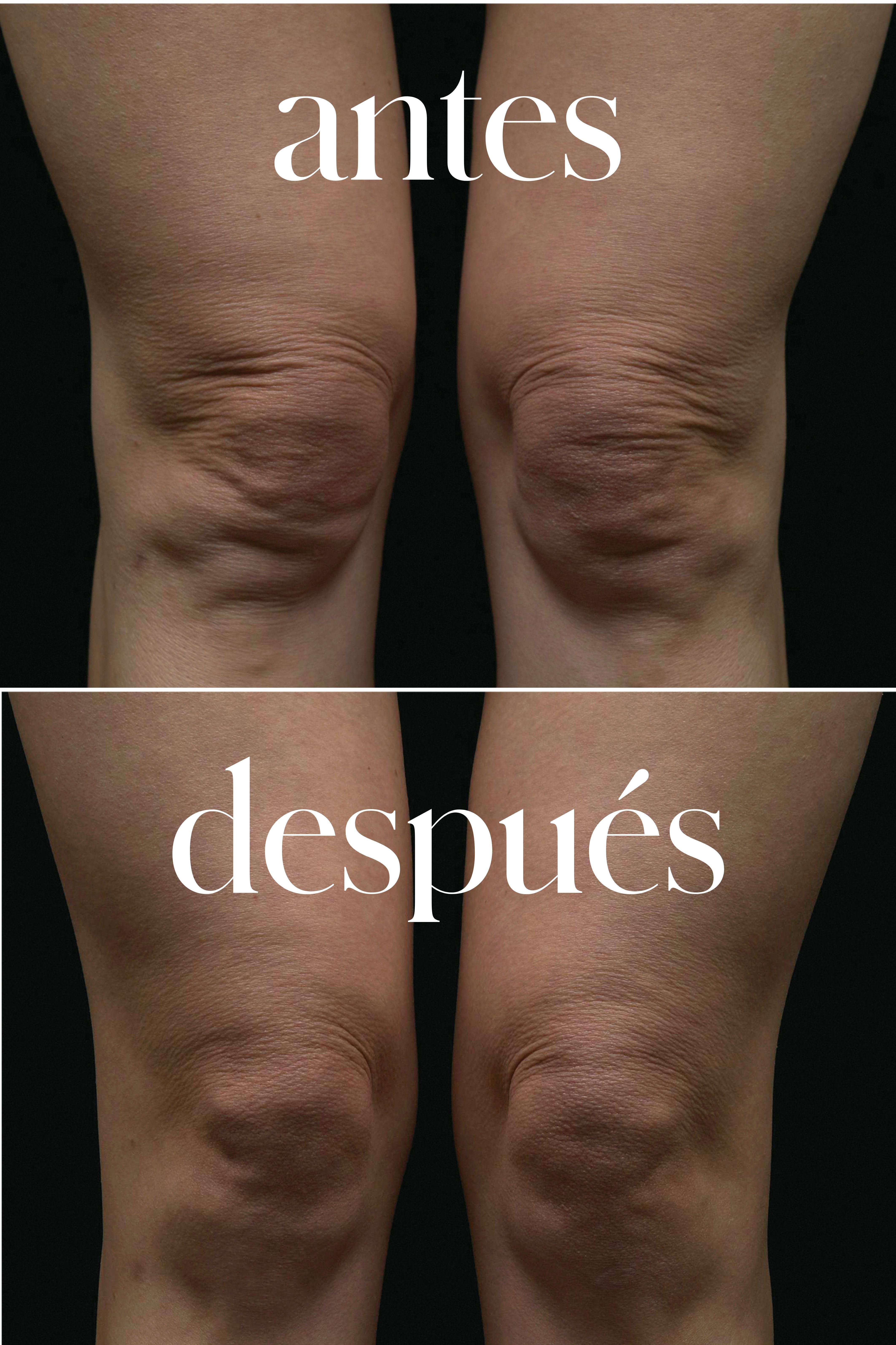 El efecto en rodillas de Themage FLX.