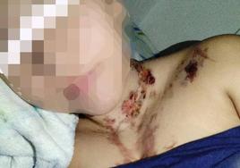 La joven de 18 años, con quemaduras en el cuello, después de que su pareja la rociara con alcohol y le prendiera fuego.