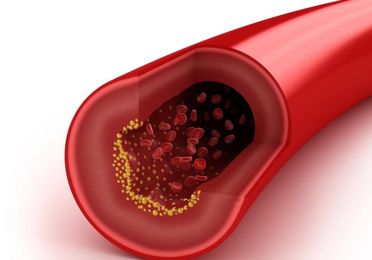 Colesterol en una arteria, en una imagen en 3D.