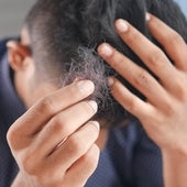 No vayas a Turquía: aquí tienes los mejores tratamientos para la alopecia