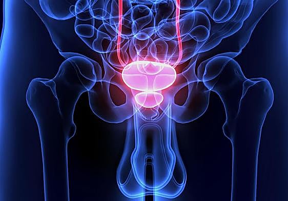 Descubren 187 nuevas variantes genéticas relacionadas con el cáncer de próstata
