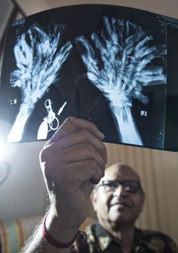 Imagen - El cirujano Samanta Lal Sen, con una radiografía de las manos de Bajandar.