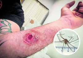 Imagen de la lesión que le causó en el brazo a un vizcaíno la mordedura de esta araña.