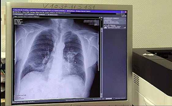 Un estudio identifica un mecanismo de resistencia a la inmunoterapia en pacientes con cáncer de pulmón