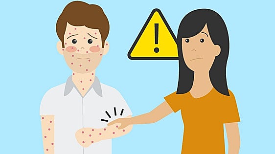 Qué es la viruela del mono y cómo se contagia