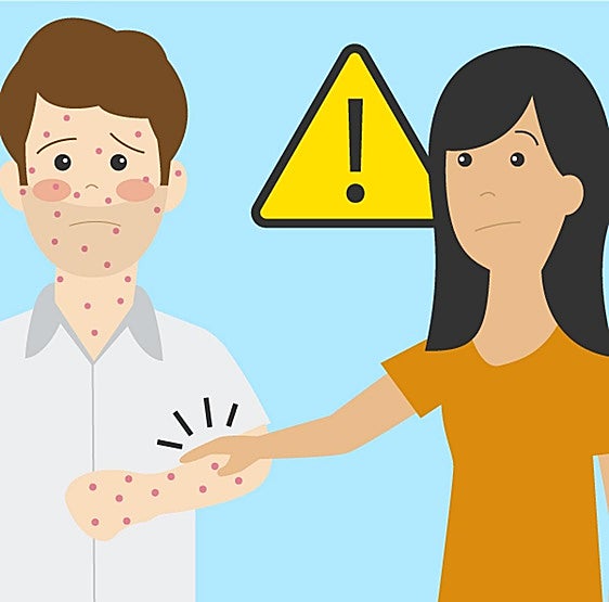 Qué es la viruela del mono y cómo se contagia