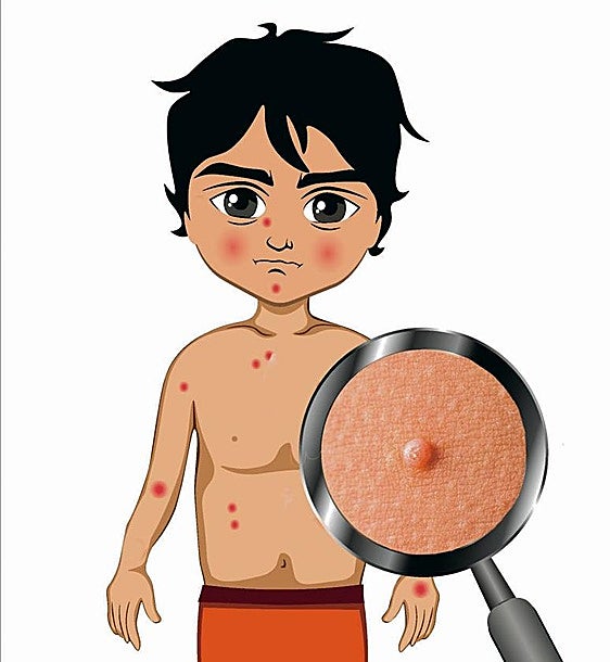 Moluscos contagiosos: así se acaba con estas latosas lesiones de la piel