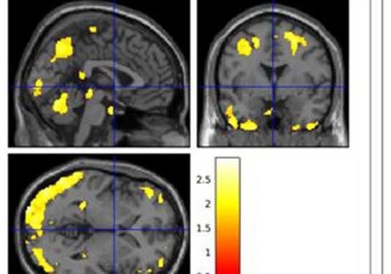 Imágenes del flujo sanguíneo cerebral en individuos comparados por su grasa corporal y otros marcadores metabólicos, para relacionarlos con las proteínas características del alzhéimer.