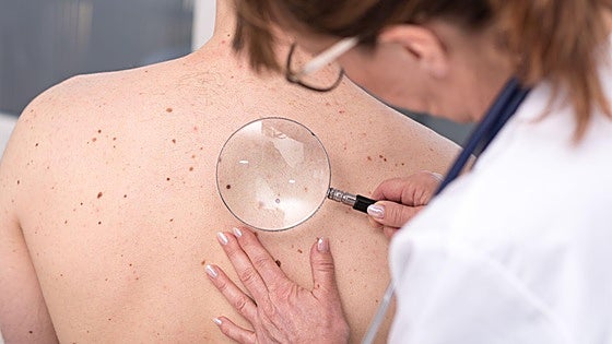 Una investigación del CNIO desvela cómo el melanoma logra ocultarse y resistir a la inmunoterapia
