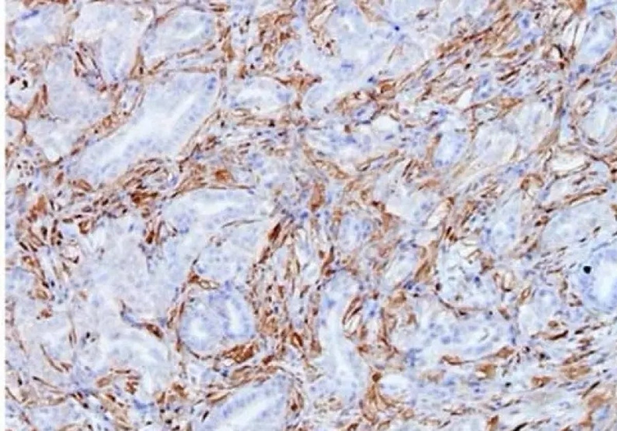 Células tumorales de cáncer de páncreas del modelo Kras.